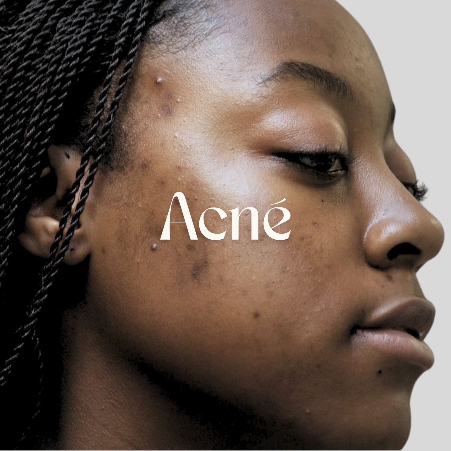 Acné
